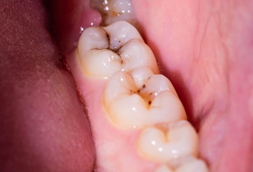 Cavities and Tooth Decay